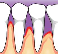 Developed periodontitis